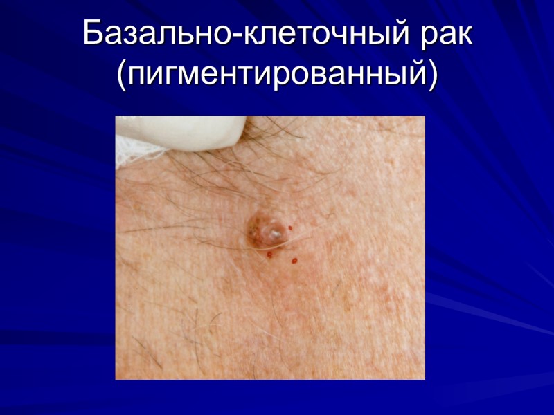 Базально-клеточный рак (пигментированный)